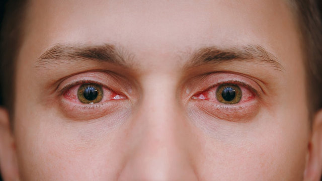 ۵ دلیل احتمالی قرمزی چشم‌ها