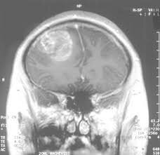 کمک زهر عقرب به تشخیص سرطان مغز