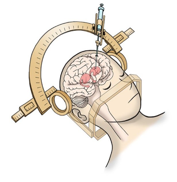 نخستین عمل پیوند سلول‌های بنیادی به مغز بیماران مبتلا به پارکینسون